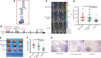 Microbiome Related Cytotoxically Active CD8+ TIL Are Inversely Associated With Lung Cancer Development